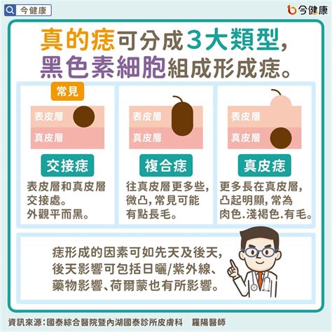 乳頭長痣|是痣？皮膚癌？還是什麼？常見Q&A解惑！醫教揪出「。